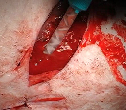 GRO-KLOT traumatic wound treatment